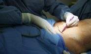 A Tummy Tuck is a Good Way to Lose Weight